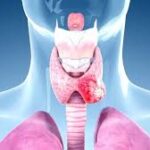 thyroid cancer treatment