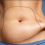 liposclupture