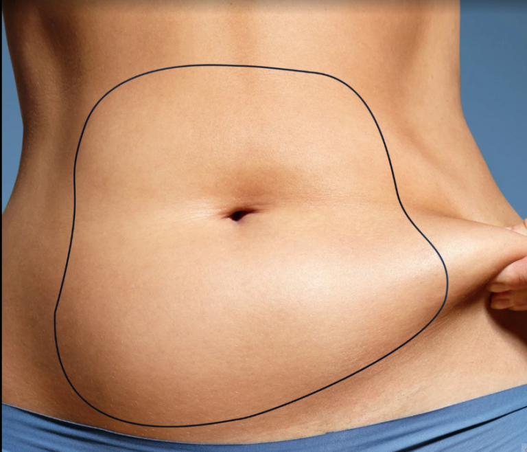 liposclupture