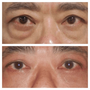 Eye Bag Removal in Dubai