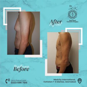 gynecomastia surgery islamabad