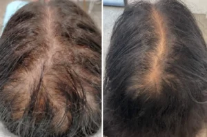 Hair Loss treatment in India 1