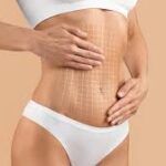 Liposuction in Dubai
