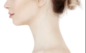 Neck Liposuction In Dubai