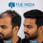 Hair Transplant Before and After