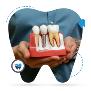 Dental-Implants-1024x1024