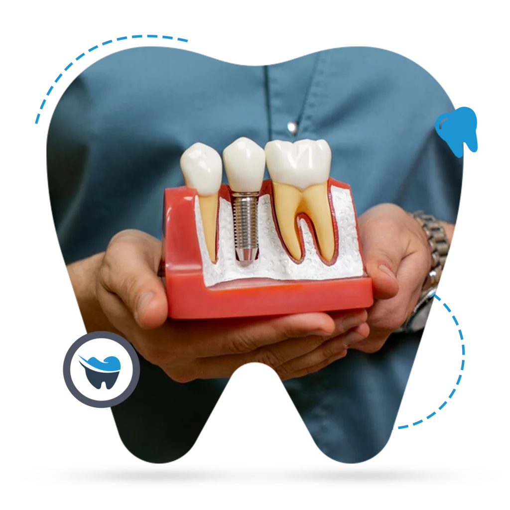 Dental-Implants-1024x1024
