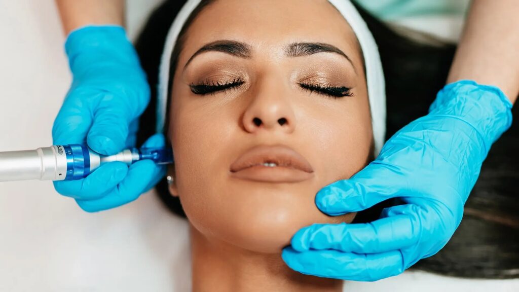 Facial Microneedling in Lauderdale Beach