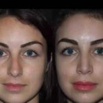 Septoplasty in Dubai