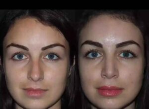 Septoplasty in Dubai