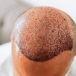 Hair-transplant