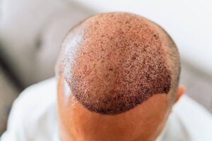 Hair-transplant