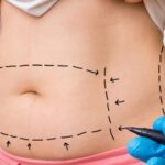Best mini tummy tuck dubai