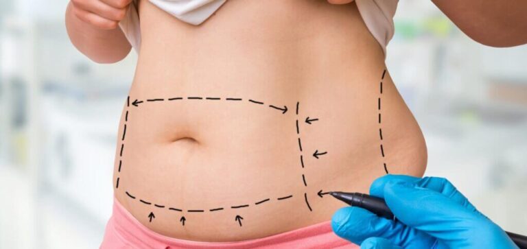 Best mini tummy tuck dubai