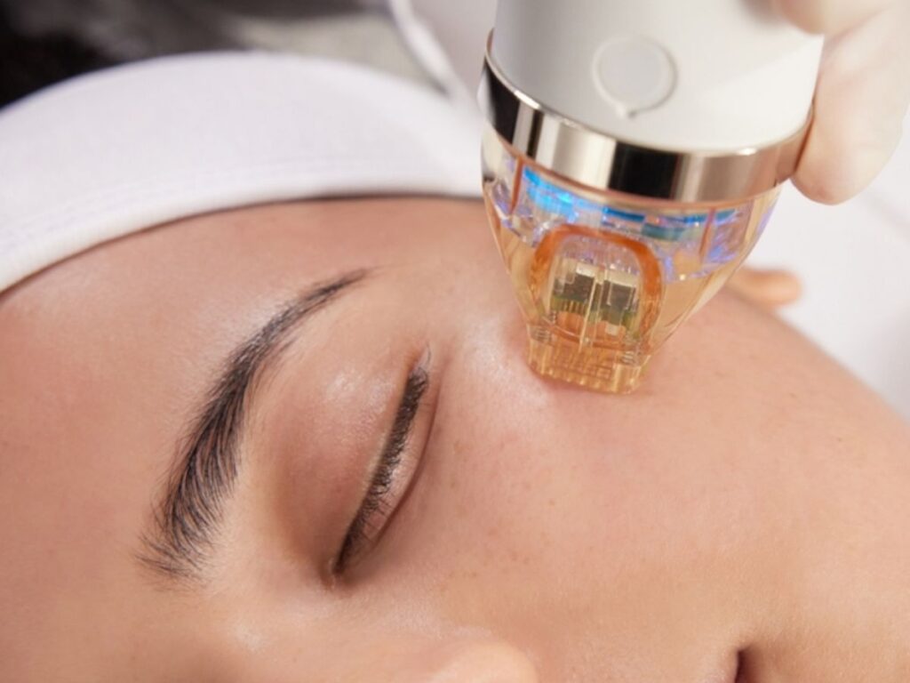 Microneedling Treatment Houston