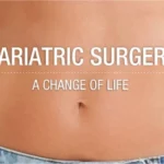 bariatric surgery in Islamabad