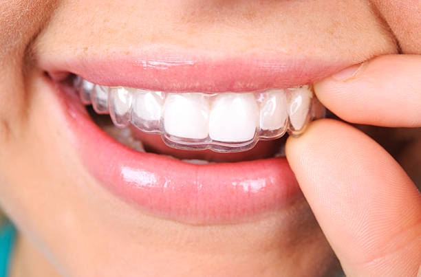 Why Teeth Retainers in Islamabad Are Essential for a Lifetime Straight Smile