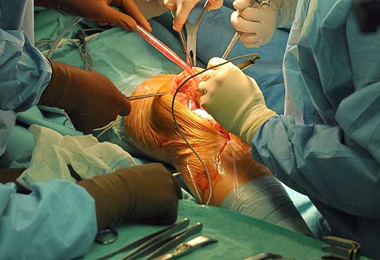 Knee Replacement in India