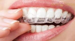 Invisalign Malaysia