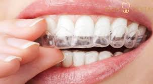 Invisalign Malaysia