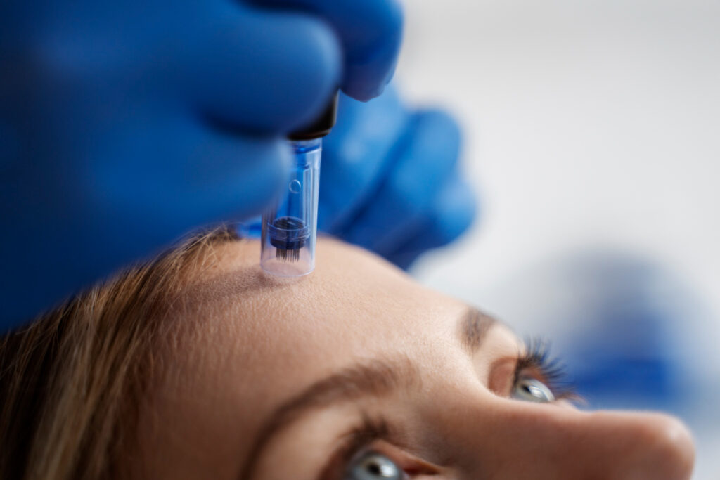 Skinpen Microneedling in Altrincham