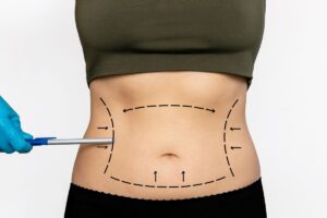tummy tuck surgery in Islamabad