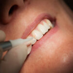 Saving Your Natural Smile: The Complete Guide to Root Canal Treatment in Bundoora