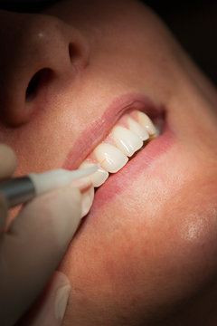 Saving Your Natural Smile: The Complete Guide to Root Canal Treatment in Bundoora