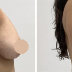 Breast-Lift