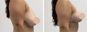 Breast-Lift