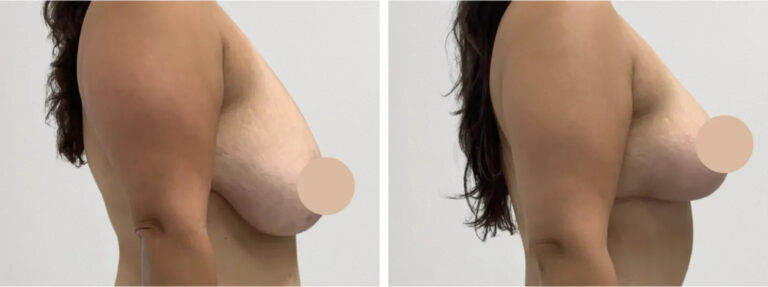 Breast-Lift