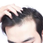 PRP Hair Treatment Dubai