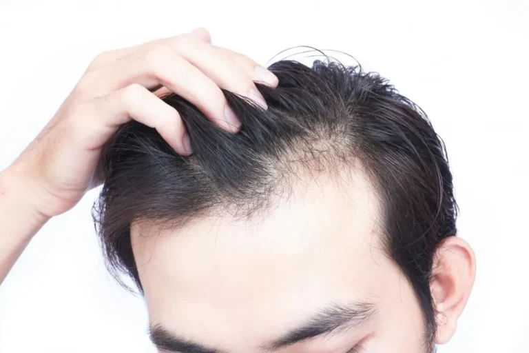 PRP Hair Treatment Dubai