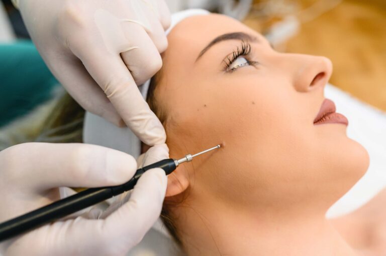 Mole Removal in London