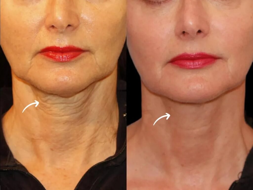 sculptra in dubai