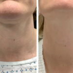 Best Doctors in dubai Performing RF Microneedling Wrinkle Reduction