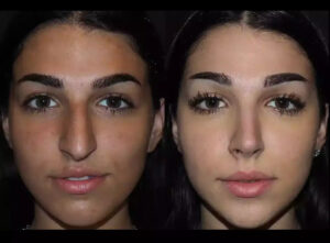 Septoplasty in Dubai