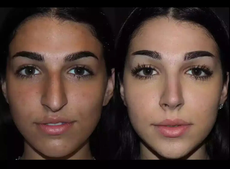 Septoplasty in Dubai