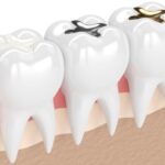 Teeth Filling2