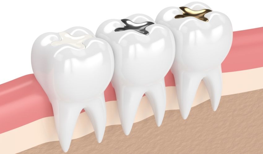 Teeth Filling2