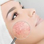 IPL épilation autour de moi