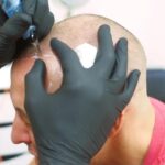 Scalp Micropigmentation Dubai