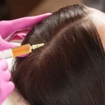 Meso Therapy for Hair