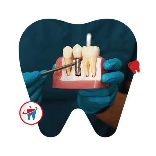 teeth implant Perth, teeth implants, teeth implant in Perth
