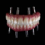 Dental-Implants