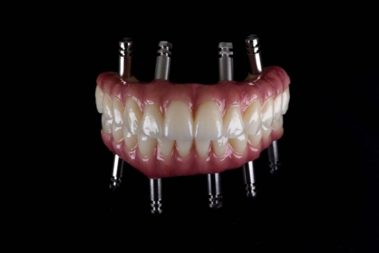 Dental-Implants