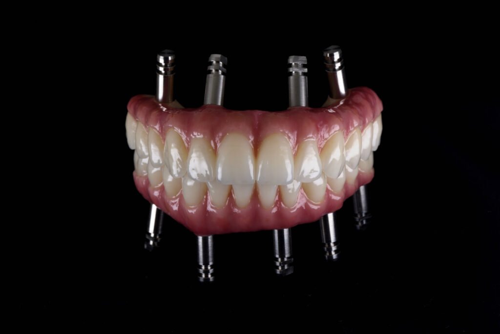 Dental-Implants