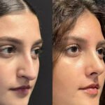 Rhinoplasty in Dubai