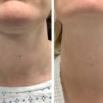 Best Plastic Surgeons in dubai for Personalized Radiofrequency Microneedling Treatments