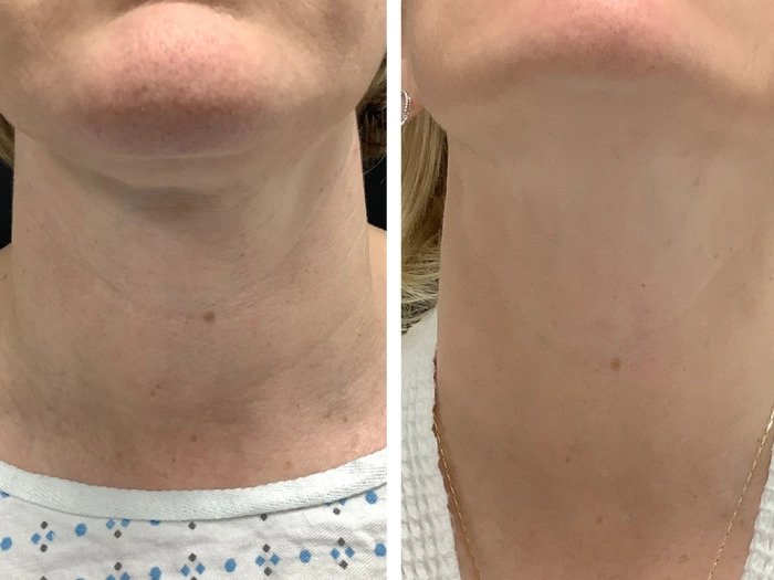 Best Plastic Surgeons in dubai for Personalized Radiofrequency Microneedling Treatments
